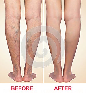 Treatment of varicose before and after. Varicose veins on the legs.