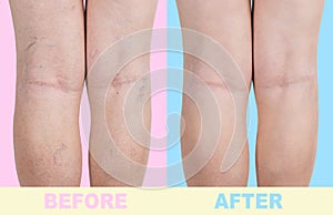 Treatment of varicose before and after. Varicose veins on the legs.