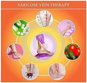 Treatment of varicose veins