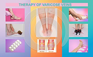Treatment of varicose veins