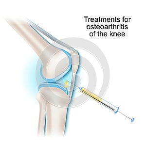 Treatments for osteoarthritis of the knee joint photo