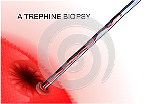 Trephine biopsy cancer tumor photo