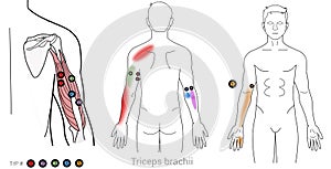 Triceps brachii: Managing pain arriving from myofascial trigger points in the upper arm.
