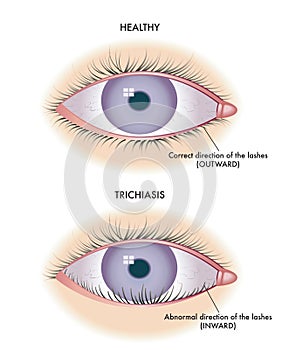 Trichiasis