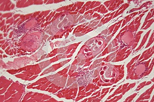 Trichinella spiralis larvae in muscle tissue under the microscope.