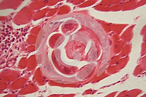 Trichinella spiralis larvae in muscle tissue under the microscope.