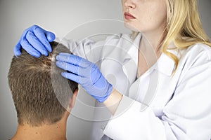 A trichologist examines the hair of a man who begins alopecia. Consultation with a dermatologist. Hair loss, alopecia, pruritus,