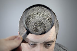 A trichologist examines a young manÃ¢â¬â¢s gray hair under a magnifying glass. Earlier bleaching of hair and pigment as a sign of low