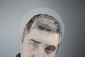 A trichologist examines a young manâ€™s gray hair under a magnifying glass. Earlier bleaching of hair and pigment as a sign of low