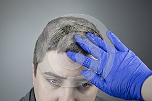 A trichologist examines a young manâ€™s gray hair under a magnifying glass. Earlier bleaching of hair and pigment as a sign of low