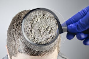 A trichologist examines a young manâ€™s gray hair under a magnifying glass. Earlier bleaching of hair and pigment as a sign of low