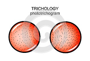 Trichology. phototrichogram. dermatology