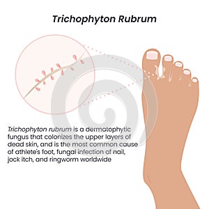 Trichophyton Rubrum fungus vector illustration graphic photo