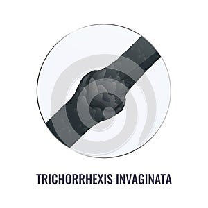Trichorrhexis invaginata hair brittle disorder in close up