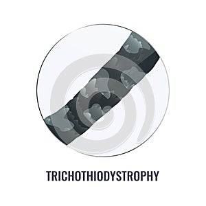 Trichothiodystrophy hair brittle disorder in close up