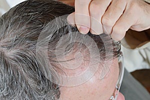 Trichotillomania, human impulse behavioral problem,hair pulling disorder photo