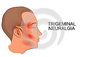 Trigeminal neuralgia. neuroscience photo