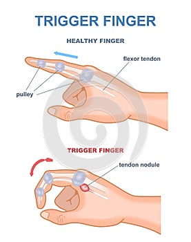 Trigger finger diagram