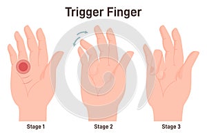 Trigger finger or finger lock. Disease causing pain, stiffness, and a sensation