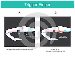 Trigger finger. illustration explain a symptom of locked finger caused by a problem with the tendon of human finger photo