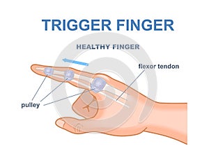 Trigger finger vector concept