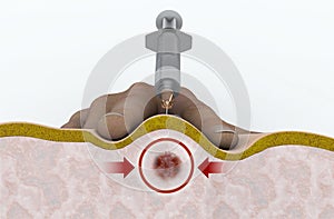 A trigger point injection is an outpatient procedure designed to reduce or relieve the back pain caused by trigger points Intramus