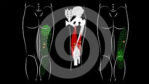 Trigger points and reflected pain in the hamstring muscles