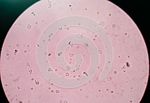 Triple phosphate crystals in urine.