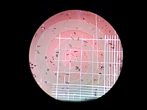 Triple phosphate crystals on urine test