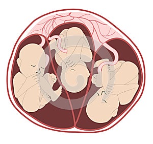 Triplets in utero from an anterior. three fetuses in the uterus. Multiple pregnancy. risk factor. Separate amniotic sacks, one