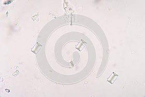 Tripple phosphete cystal in urine. photo