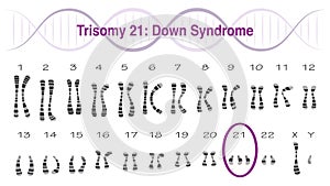 Trisomy 21: Down Syndrome Karyotype