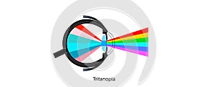 Tritanopia and tritanomaly photo