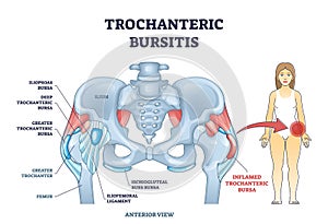 Trochanteric bursitis as bursa inflammation located in hip outline diagram