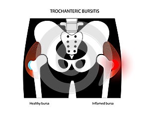 Bursitis inflammation concept photo