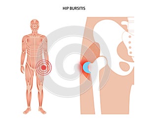 Bursitis inflammation concept photo