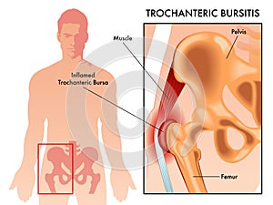Trochanteric bursitis medical illustration