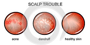 Troubled scalp. dermatology