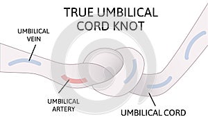 True umbilical cord knot. umbilical cord forms a knot inside the womb. Danger for child