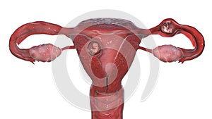 Tubal ectopic pregnancy, 3D illustration photo