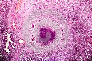 Tubercle, light micrograph