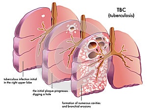 Tuberculosis photo