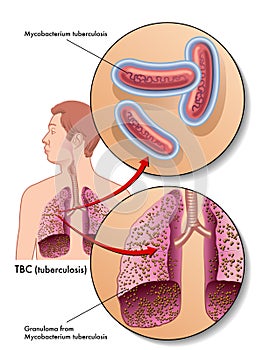 Tuberculosis