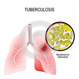 Tuberculosis is an infection caused by bacteria. Lungs of infect