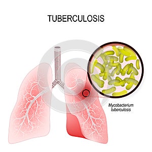 Tuberculosis is an infection caused by bacteria. Lungs of infect photo