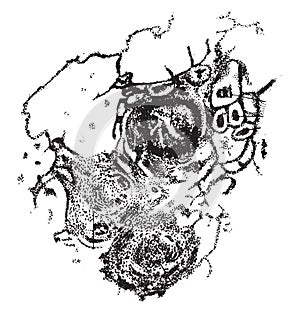Tuberculosis of the lung, vintage engraving