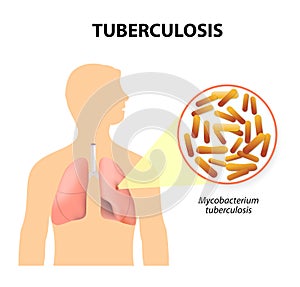Tuberculosis, MTB or TB photo