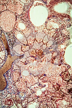 Tuberculosis tissue
