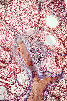 Tuberculosis tissue