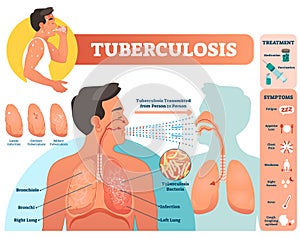 Tuberculosis vector illustration. Detailed symptoms and treatment scheme.